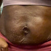 Loose_Skin_Stretch_Mark_Before