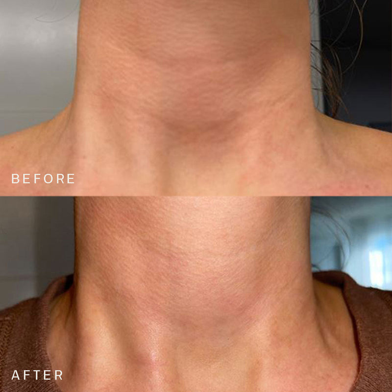 Neck Occlusion Patch™