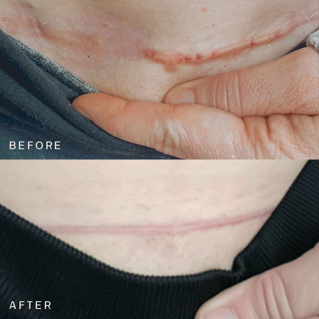 The Cesarean Occlusion Patch®