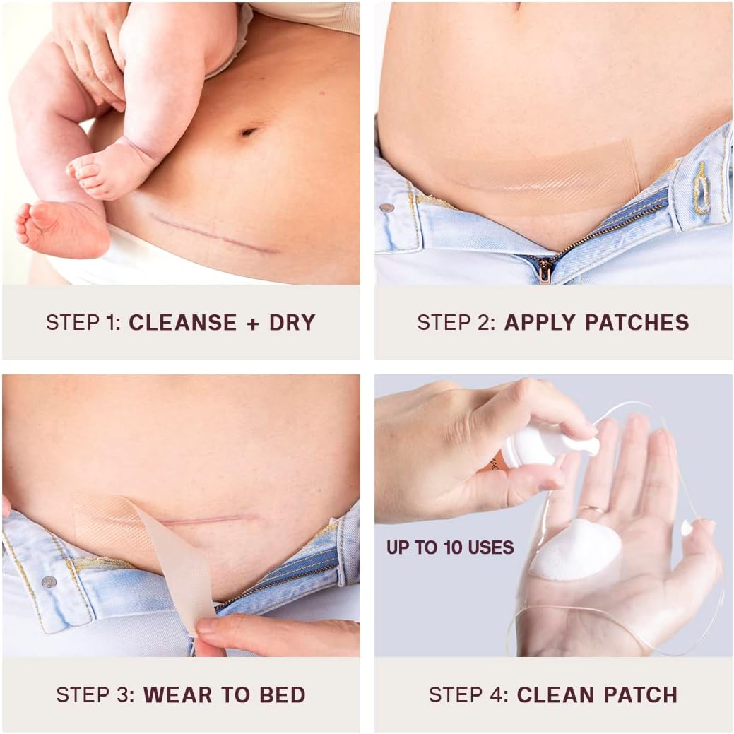 The Cesarean Occlusion Patch®