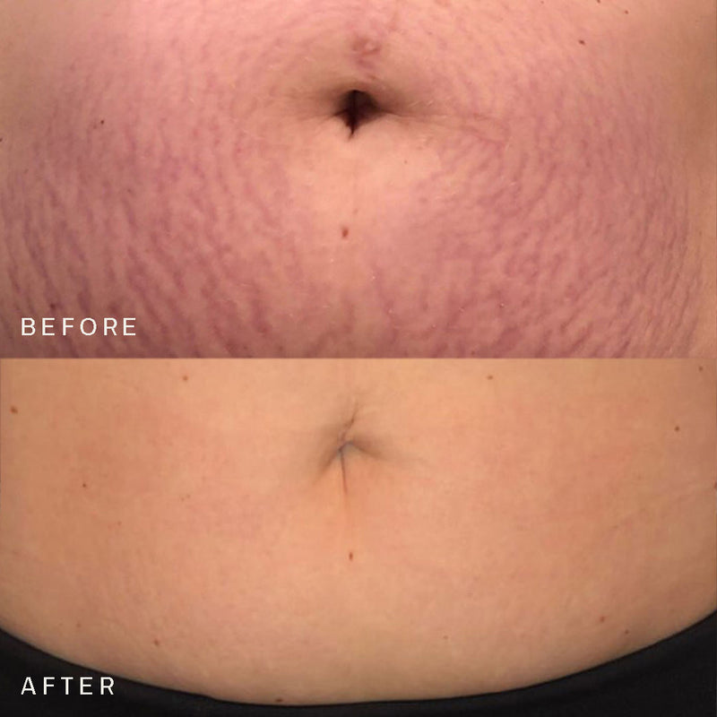 Belly & Body Stretch Mark Kit