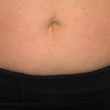 Stretch-Mark-Removal-Product-After