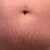 Stretch_Mark_Before