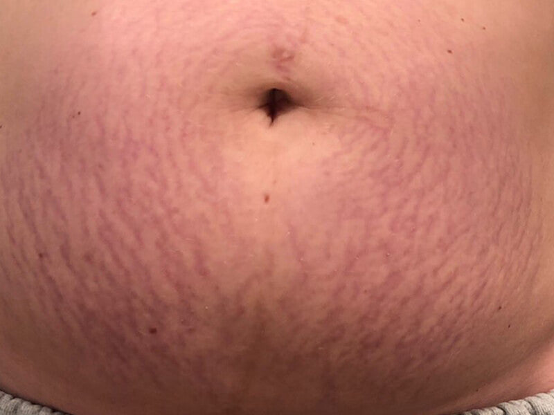 Stretch_Mark_Before