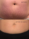 90-DAY STRETCH MARK & LOOSE SKIN RESULTS