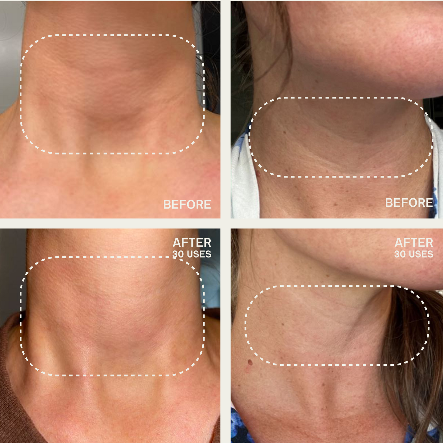 The Neck & Décolleté Occlusion Patch®