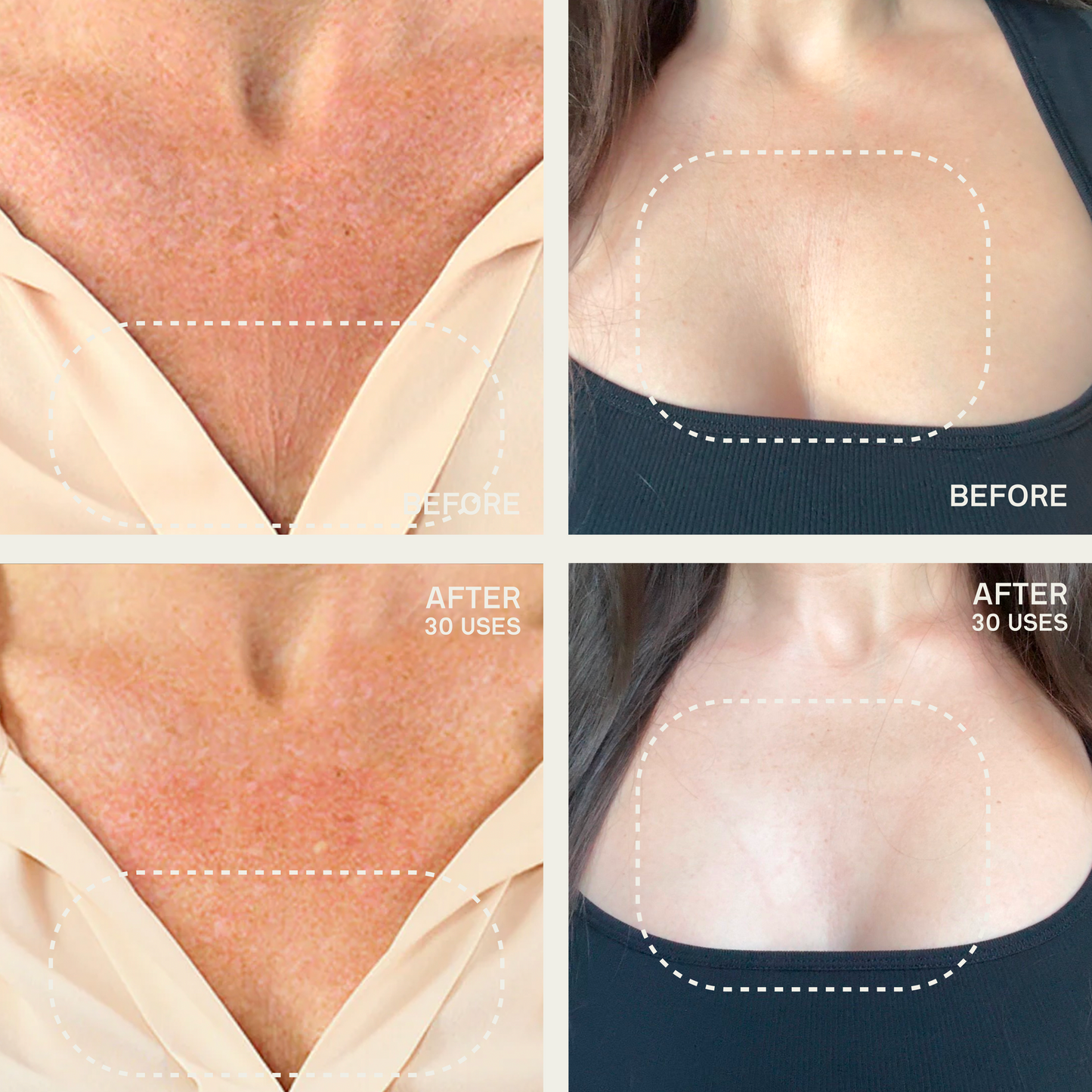 The Neck & Décolleté Occlusion Patch®