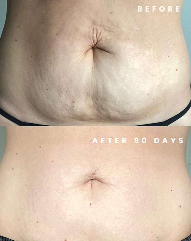 90-DAY STRETCH MARK FREE RESULTS
