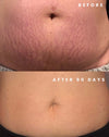 90-DAY STRETCH MARK FREE RESULTS