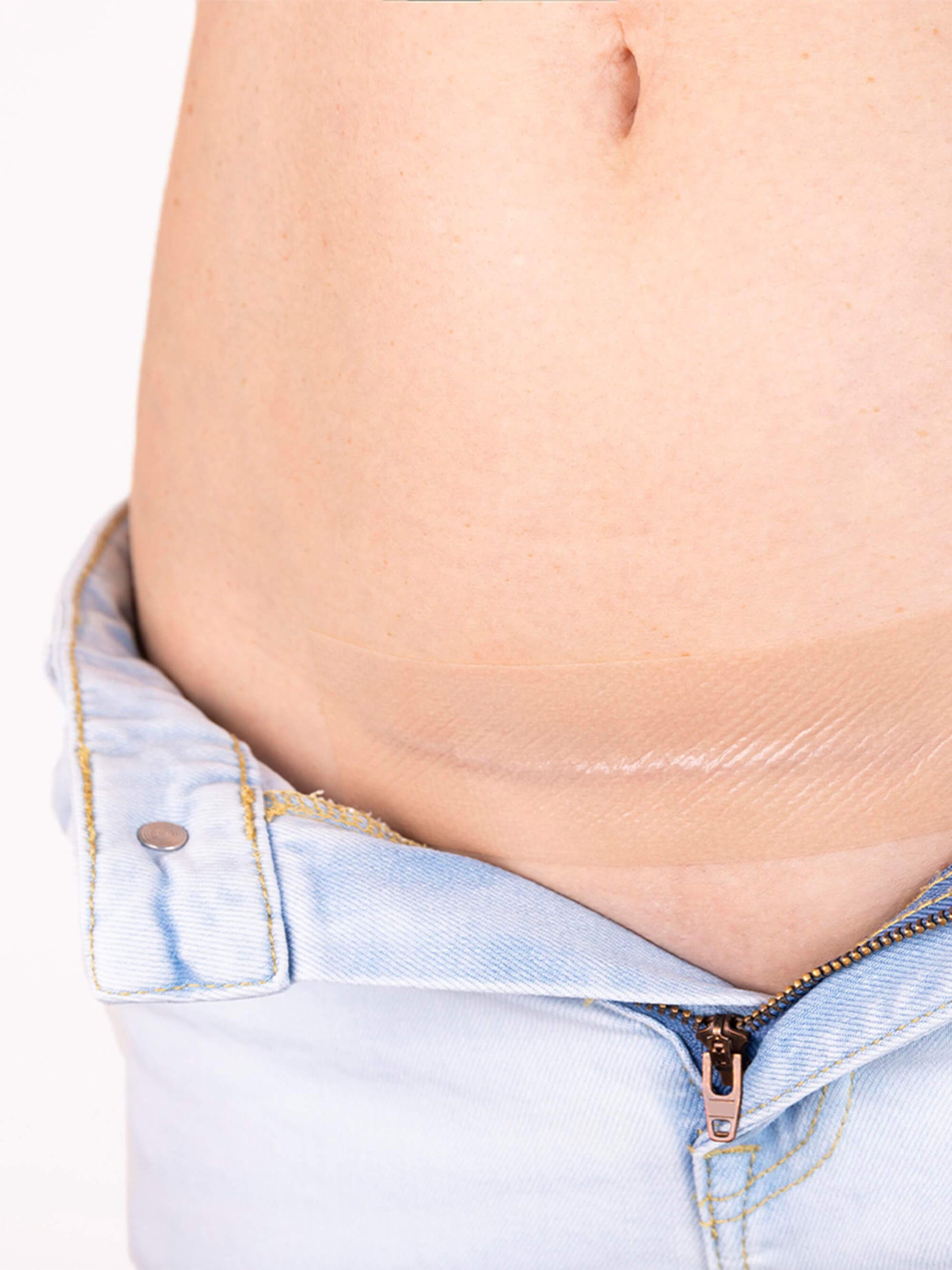 C-Section-Scar-Removal-Patch